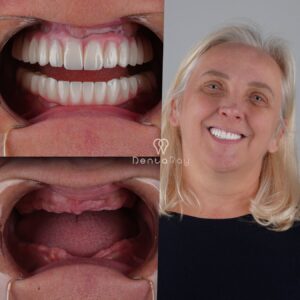 International Patient to Istanbul Dentaray Clinic for All on 4 Dental Implants