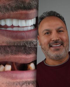 Dental Implant All on 6