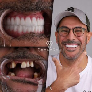 cost Zygomatic Dental Implants in Turkey