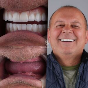 dental implants in turkey all inclusive packages