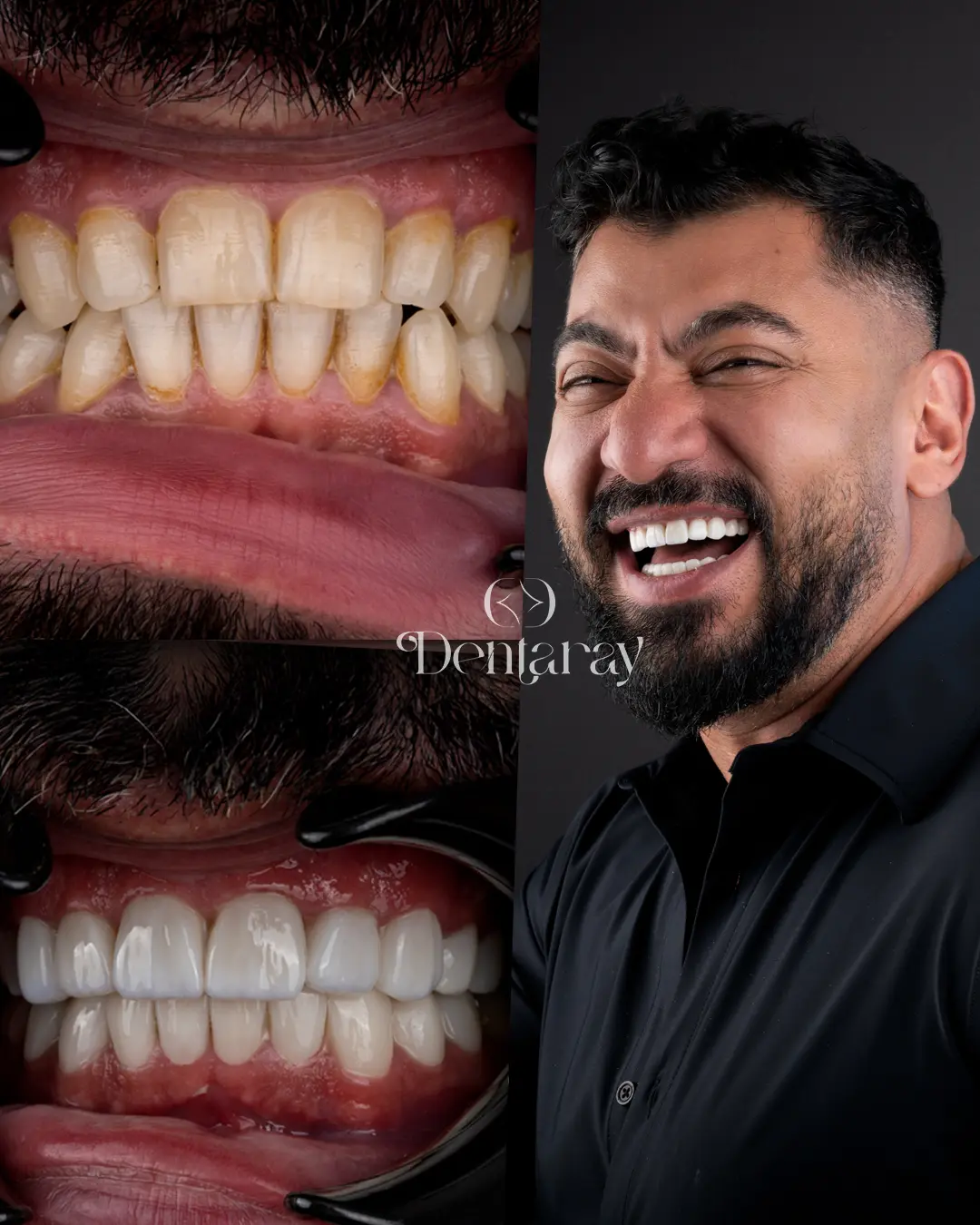 Dental Veneers
