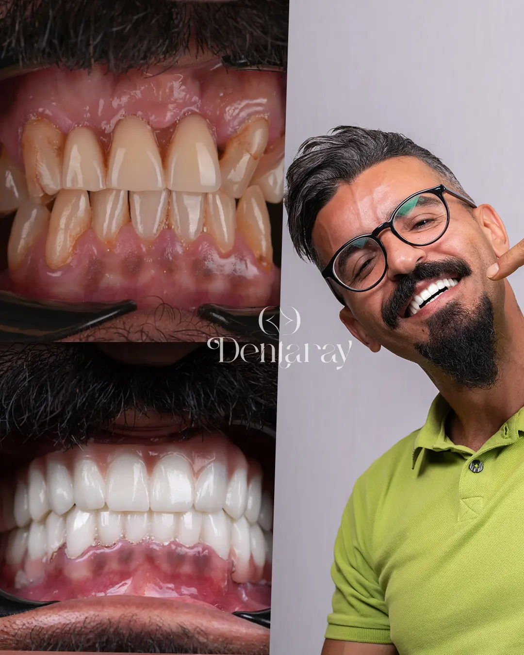 Hollywood Smile