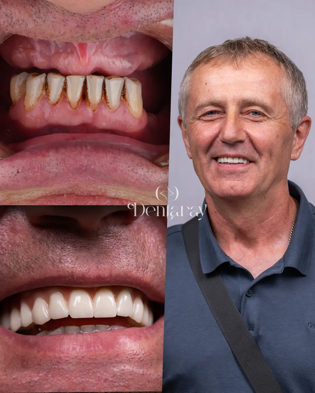 All-on-4 Dental Implants