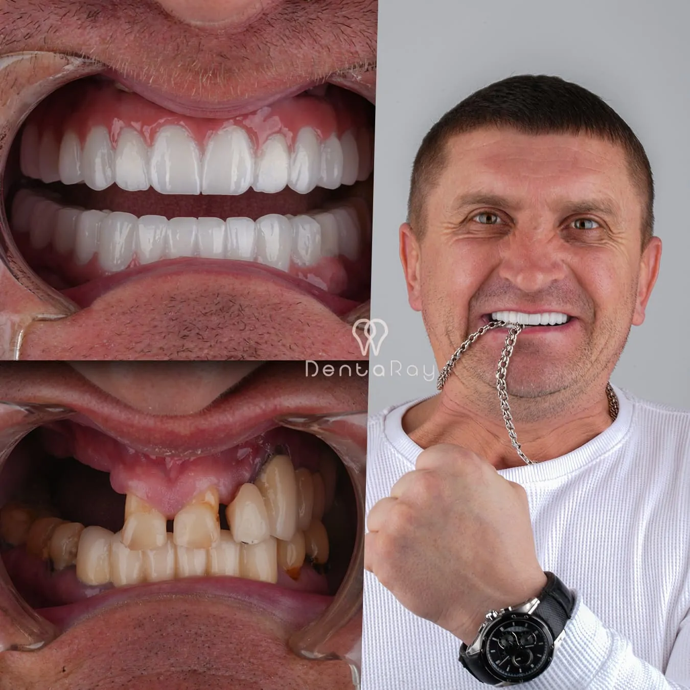 Новая улыбка